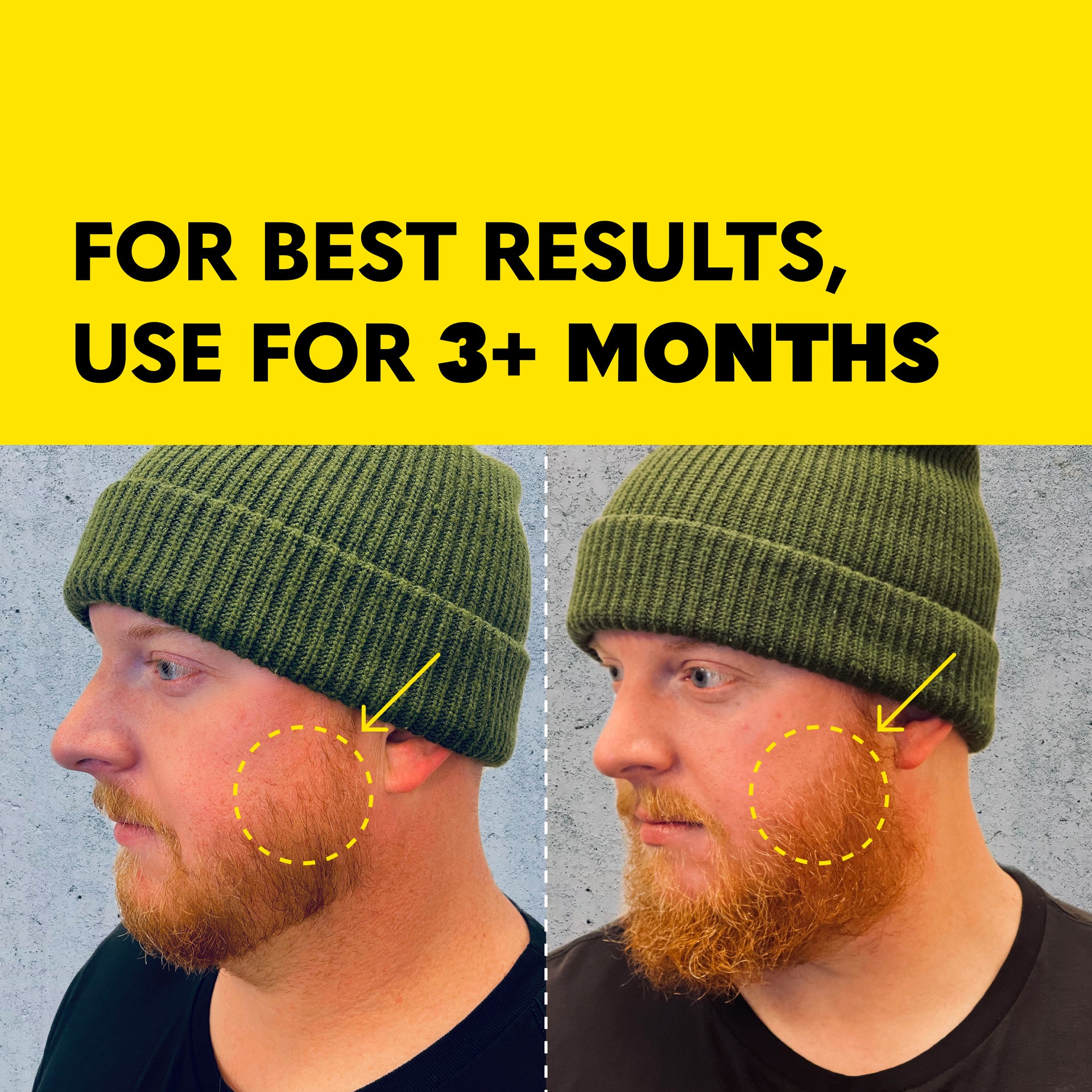 Beard Derma Roller